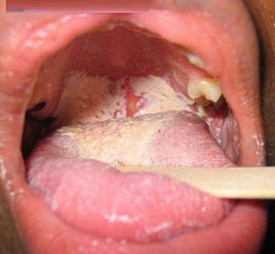 Triệu chứng bệnh giang mai ở miệng